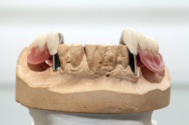 Zirkonyum porselen diş plaka dişçi mağaza