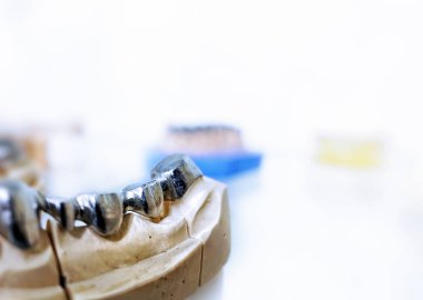 Diş diş porselen protez diş hekimi