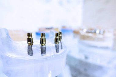 Diş diş porselen protez diş hekimi