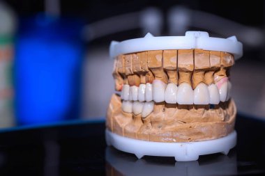 Dental Tooth Porcelain Prosthesis in Dentist clipart