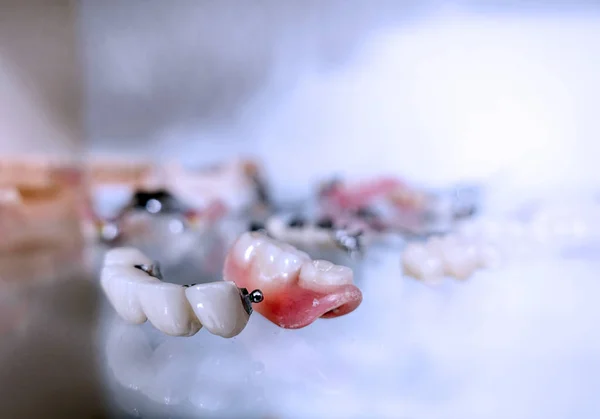 Zahnprothese Aus Porzellan Beim Zahnarzt — Stockfoto