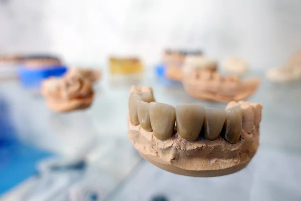 Dental Tooth Porcelain Prosthesis Dentist — Stock Photo, Image