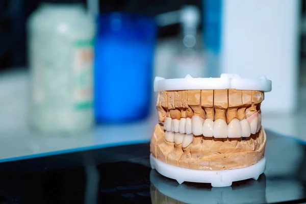牙科牙瓷假体 — 图库照片