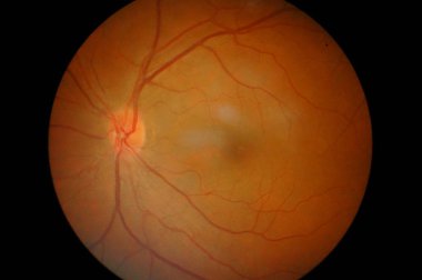 eye diabetes symtom.