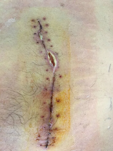 Cuciture chirurgia calcoli biliari ferita . — Foto Stock
