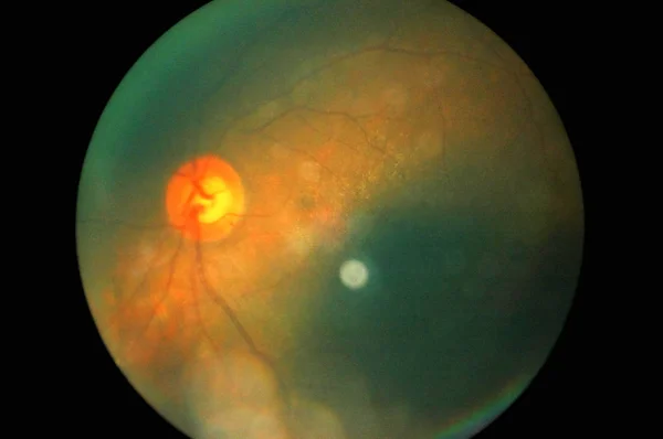 Retina of diabetes — Stock Photo, Image