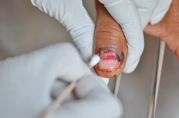 Dressing thumb nail wound. — Stock Photo, Image