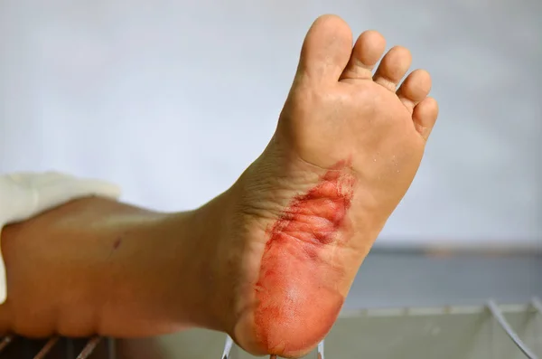 Foot with blood. — Stock Photo, Image