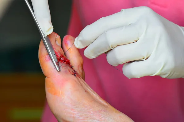 Suturing laceration wound. — Stock Photo, Image