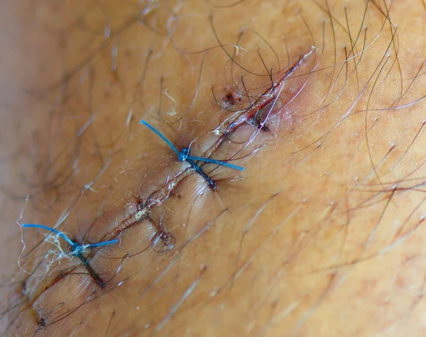 Patient cut Suture stitches — Stock Photo, Image