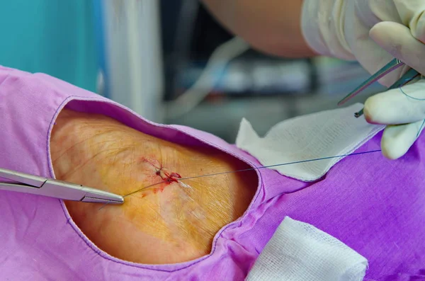 Ferita da sutura dell'infermiera . — Foto Stock