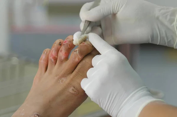 Cleaning finger wound. — Stock Photo, Image