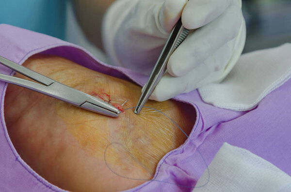 Suturing incision wound.
