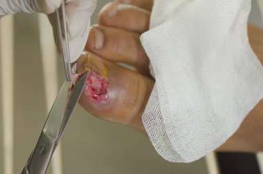 Başparmak çivi kaza oldu.