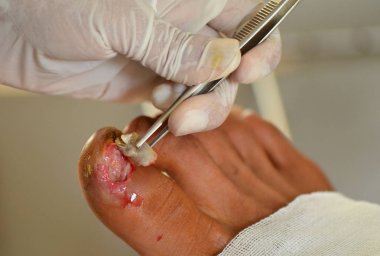 Hasta tırnak yarası vardı.