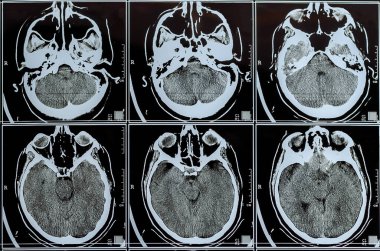 Beynin MR taraması. MRI beyin taraması ya da röntgen nörolojisi kafa tomografisi testi. Manyetik rezonans tomografisi. Seçici odak.
