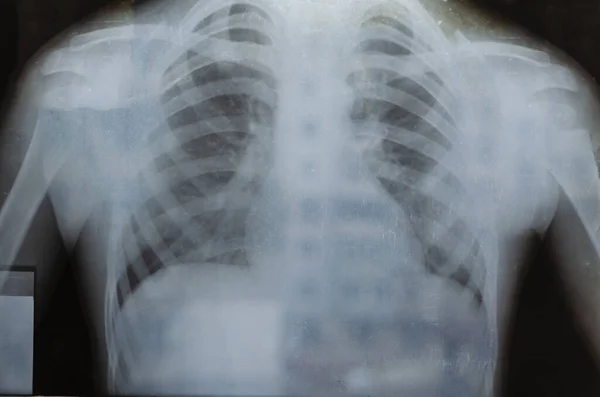 Röntgen Der Brust Eines Kleinen Jungen Röntgen Eines Jährigen Kindes — Stockfoto