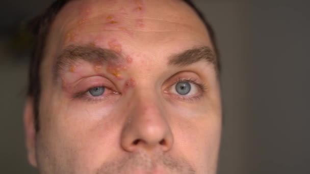 Cara masculina afetada pelo Herpes Zoster: bolhas purulentas na testa — Vídeo de Stock