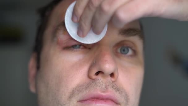 Uomo con herpes zoster, herpes zoster, sul viso tratta vesciche purulente — Video Stock