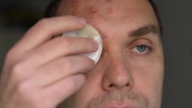 Yüzünde herpes zoster olan bir adam zehirli kabarcıkları pamukla tedavi eder.