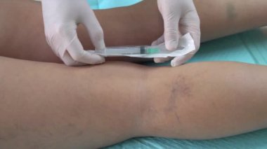Doktorlar enjeksiyondan önce şırıngayı açarlar. skleroterapi.