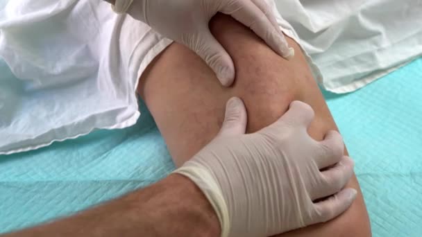 Médicos mãos em luvas de látex branco examina as veias de uma mulher com varicosa — Vídeo de Stock