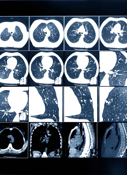 Magnetic resonance therapy of human lungs. Prevention and treatment of various diseases.