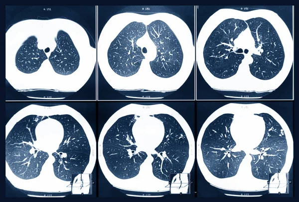 Magnetic resonance therapy of human lungs. Prevention and treatment of various diseases.