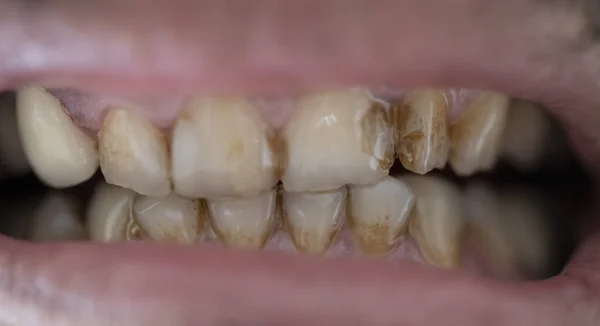 Decayed teeth close-up. There are brown spots on the tooth.