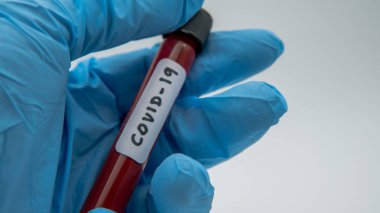 COVID-19 için enfekte kan örneği içeren test tüpü. Wuhan, Çin 'de bulunan yeni bir koronavirüs. Koruma için mavi eldivenli bilim adamı. 2019-NCoV virüsü için aşı araştırması