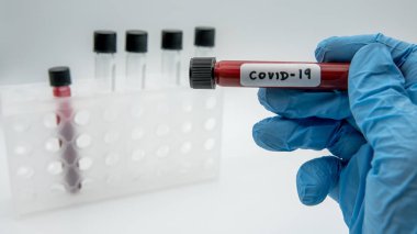 COVID-19 için enfekte kan örneği içeren test tüpü. Wuhan, Çin 'de bulunan yeni bir koronavirüs. Koruma için mavi eldivenli bilim adamı. 2019-NCoV virüsü için aşı araştırması