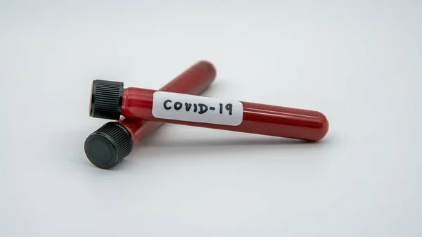 Positive Covid Test Laboratory Sample Blood Testing Diagnosis New Corona — Stock Photo, Image