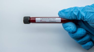 Yeni Corona virüsü enfeksiyonu teşhisi için pozitif COVID-19 testi ve laboratuvar örneği. Wuhan 'dan 2019 numaralı hastalık. Bulaşıcı salgın konsepti
