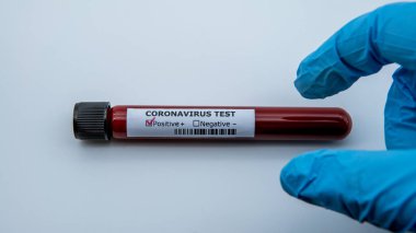 Yeni Corona virüsü enfeksiyonu teşhisi için pozitif COVID-19 testi ve laboratuvar örneği. Wuhan 'dan 2019 numaralı hastalık. Bulaşıcı salgın konsepti