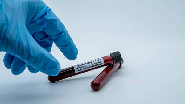 Positivt Covid Test Och Laboratorieprov Blodprov För Diagnos Corona Virusinfektion — Stockfoto