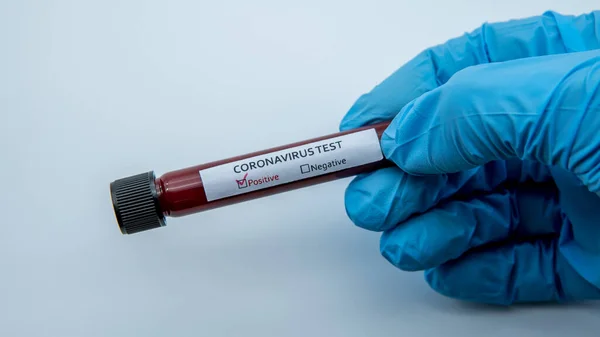 Θετική Δοκιμή Covid Και Εργαστηριακό Δείγμα Της Εξέτασης Αίματος Για — Φωτογραφία Αρχείου
