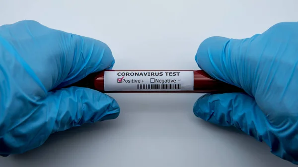Positive Covid Test Laboratory Sample Blood Testing Diagnosis New Corona — Stock Photo, Image