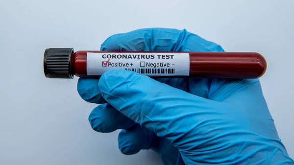 Pozitivní Covid Test Laboratorní Vzorek Krevních Testů Pro Diagnostiku Nové — Stock fotografie