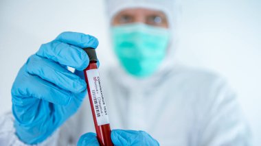 Laboratuvar teknisyeninin elinde Corona virüsü testi için pozitif kan örneği tüpü var. COVID-19. Koruma giysisi ve maskesi olan bir bilim adamı. 2019-NCoV için aşı araştırması