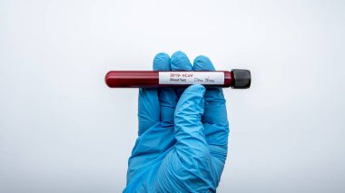 Negatif COVID-19 testi ve yeni Corona virüsü enfeksiyonu teşhisi için laboratuvar örneği. Wuhan 'dan 2019 numaralı hastalık. Bulaşıcı salgın konsepti