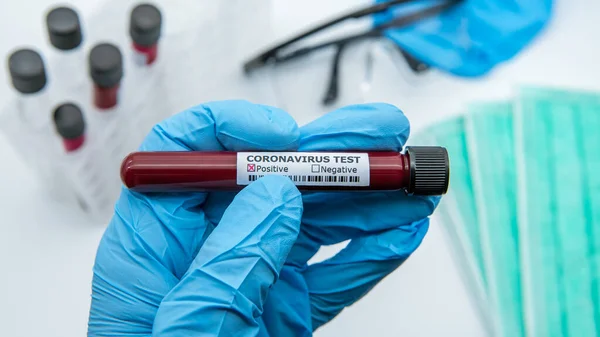 Tes Covid Positif Dan Sampel Laboratorium Tes Darah Untuk Diagnosis — Stok Foto