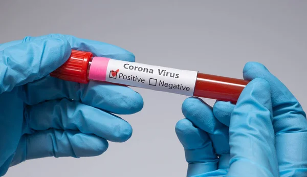 Blood positive test to coronavirus. Medical reseach, test-tube with blood, hand in latex medical gloves. Coronavirus outbreak and influenza. 2019-nCoV, covid-19, sars. High quality photo. — Stock Photo, Image