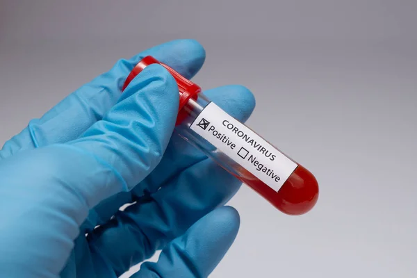 Koronavirüs için kan testi pozitif çıktı. Tıbbi müdahale, üzerinde kan olan test tüpü, lateks tıbbi eldiven. Coronavirüs salgını ve grip. 2019-ncov, covid-19, sars. Yüksek kalite fotoğraf. 