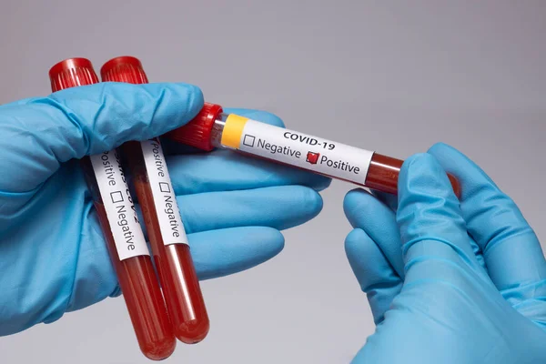 Koronavirüs için kan testi pozitif çıktı. Tıbbi müdahale, üzerinde kan olan test tüpü, lateks tıbbi eldiven. Coronavirüs salgını ve grip. 2019-ncov, covid-19, sars. Yüksek kalite fotoğraf. 