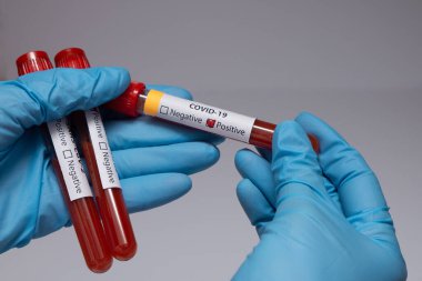 Koronavirüs için kan testi pozitif çıktı. Tıbbi müdahale, üzerinde kan olan test tüpü, lateks tıbbi eldiven. Coronavirüs salgını ve grip. 2019-ncov, covid-19, sars. Yüksek kalite fotoğraf. 