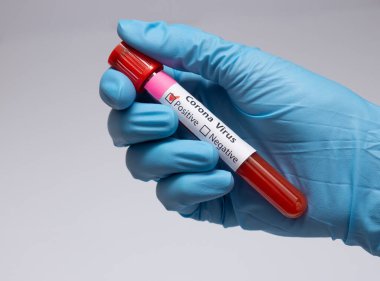 Koronavirüs için kan testi pozitif çıktı. Tıbbi müdahale, üzerinde kan olan test tüpü, lateks tıbbi eldiven. Coronavirüs salgını ve grip. 2019-ncov, covid-19, sars. Yüksek kalite fotoğraf. 
