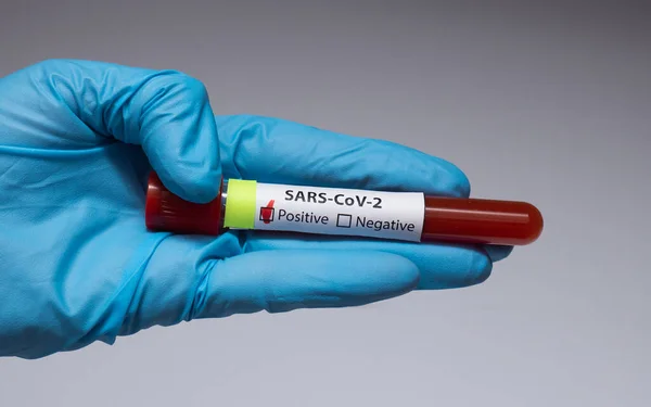 Koronavirüs için kan testi pozitif çıktı. Tıbbi müdahale, üzerinde kan olan test tüpü, lateks tıbbi eldiven. Coronavirüs salgını ve grip. 2019-ncov, covid-19, sars. Yüksek kalite fotoğraf. 