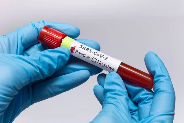 Blood positive test to coronavirus. Medical reseach, test-tube with blood, hand in latex medical gloves. Coronavirus outbreak and influenza. 2019-nCoV, covid-19, sars. High quality photo.