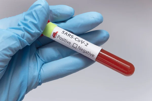 Koronavirüs için kan testi pozitif çıktı. Tıbbi müdahale, üzerinde kan olan test tüpü, lateks tıbbi eldiven. Coronavirüs salgını ve grip. 2019-ncov, covid-19, sars. Yüksek kalite fotoğraf. 