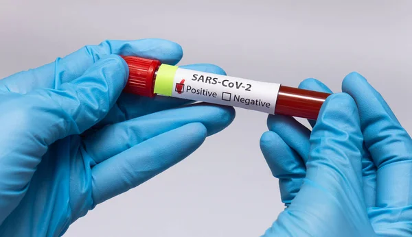 Blood positive test to coronavirus. Medical reseach, test-tube with blood, hand in latex medical gloves. Coronavirus outbreak and influenza. 2019-nCoV, covid-19, sars. High quality photo.